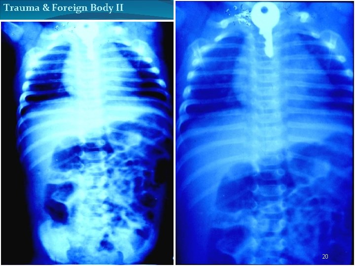 Trauma & Foreign Body II 20 