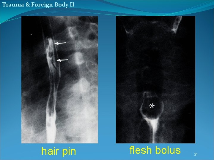 Trauma & Foreign Body II hair pin flesh bolus 21 