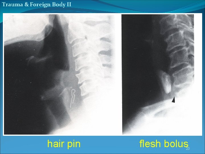 Trauma & Foreign Body II hair pin flesh bolus 23 