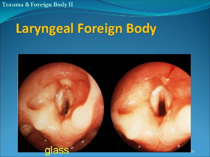 Trauma & Foreign Body II Laryngeal Foreign Body glass 28 