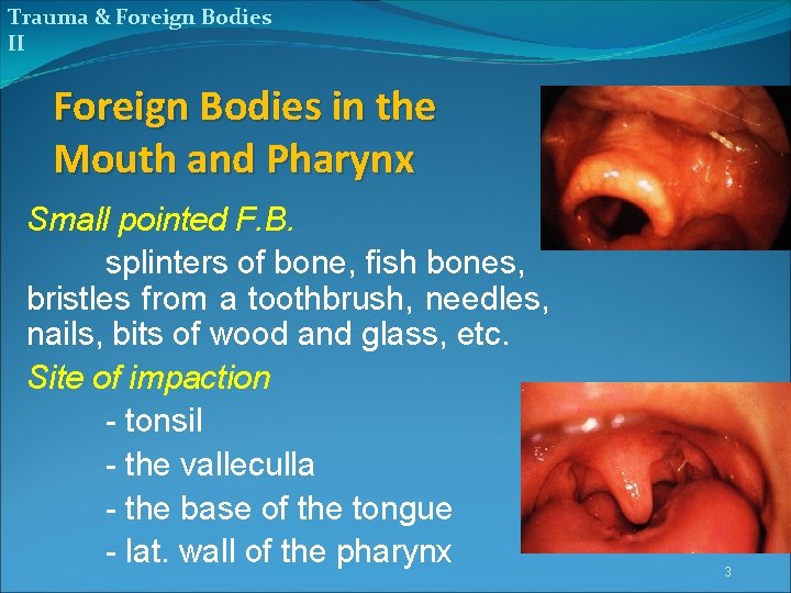 Trauma & Foreign Bodies II Foreign Bodies in the Mouth and Pharynx Small pointed