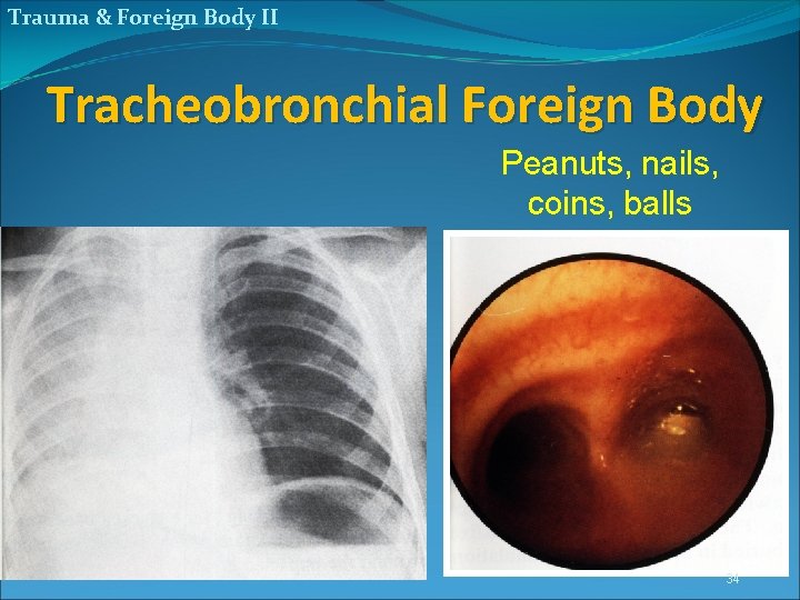 Trauma & Foreign Body II Tracheobronchial Foreign Body Peanuts, nails, coins, balls 34 