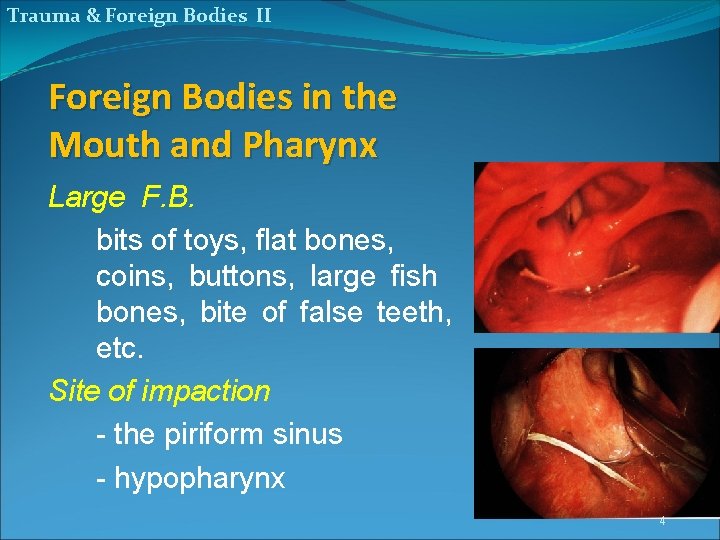 Trauma & Foreign Bodies II Foreign Bodies in the Mouth and Pharynx Large F.
