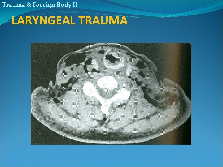 Trauma & Foreign Body II LARYNGEAL TRAUMA 