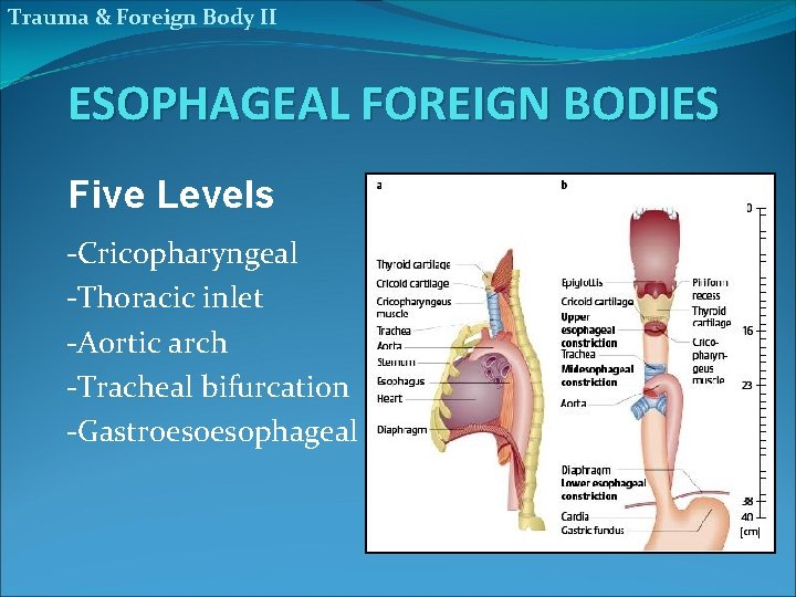 Trauma & Foreign Body II ESOPHAGEAL FOREIGN BODIES Five Levels -Cricopharyngeal -Thoracic inlet -Aortic
