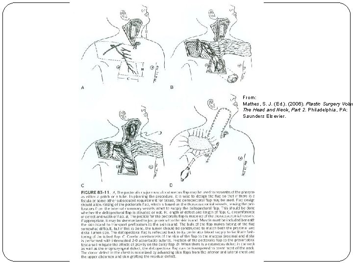 From: Mathes, S. J. (Ed. ). (2006). Plastic Surgery Volum The Head and Neck,