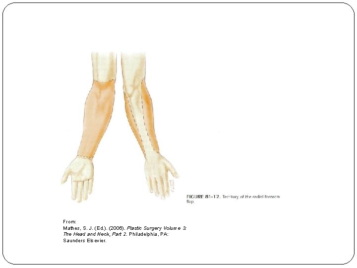 From: Mathes, S. J. (Ed. ). (2006). Plastic Surgery Volume 3: The Head and