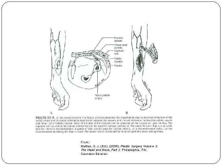 From: Mathes, S. J. (Ed. ). (2006). Plastic Surgery Volume 3: The Head and