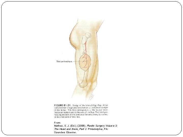 From: Mathes, S. J. (Ed. ). (2006). Plastic Surgery Volume 3: The Head and