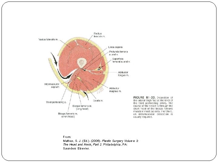 From: Mathes, S. J. (Ed. ). (2006). Plastic Surgery Volume 3: The Head and