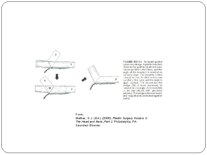 ￼ From: Mathes, S. J. (Ed. ). (2006). Plastic Surgery Volume 3: The Head