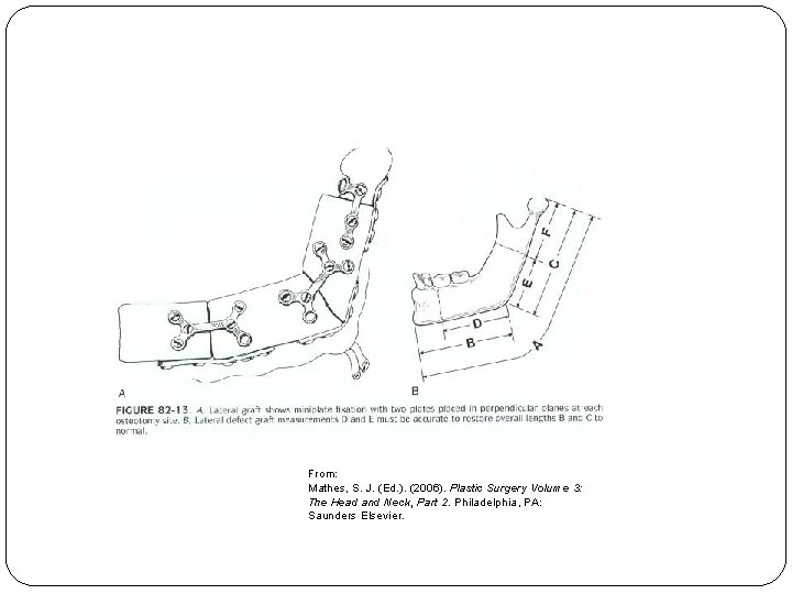 From: Mathes, S. J. (Ed. ). (2006). Plastic Surgery Volume 3: The Head and