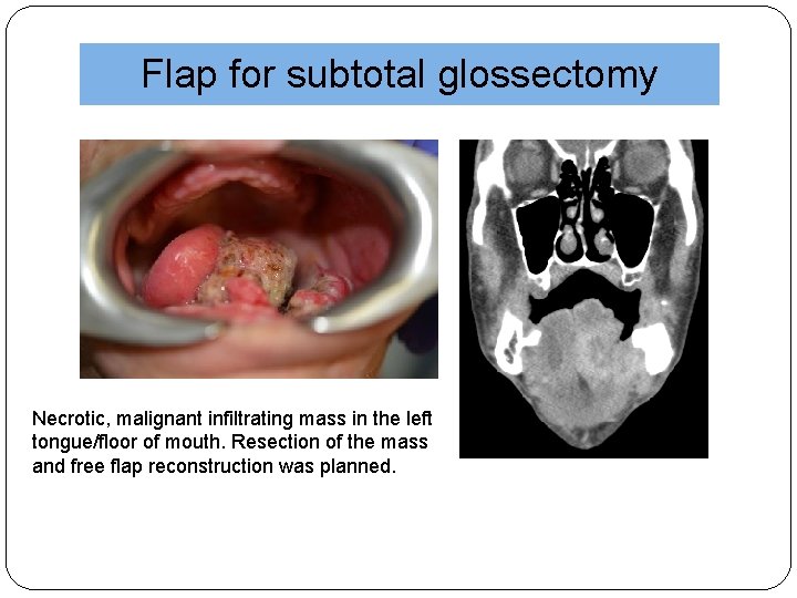 Flap for subtotal glossectomy Necrotic, malignant infiltrating mass in the left tongue/floor of mouth.