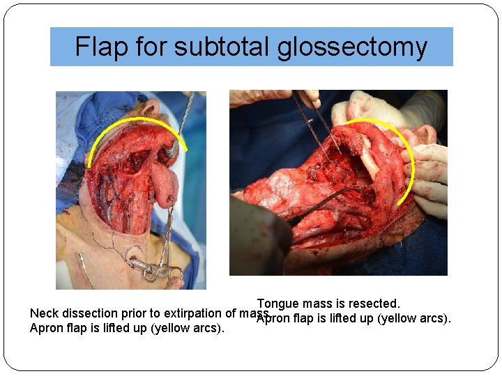 Flap for subtotal glossectomy Tongue mass is resected. Neck dissection prior to extirpation of