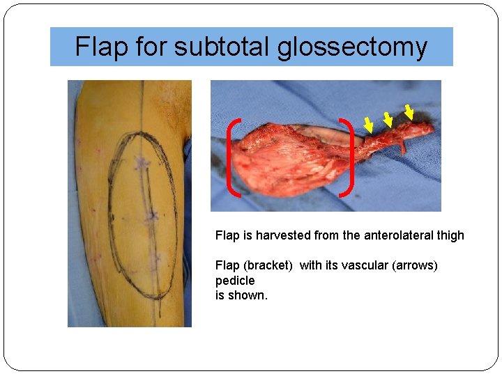 Flap for subtotal glossectomy Flap is harvested from the anterolateral thigh Flap (bracket) with