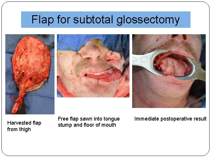 Flap for subtotal glossectomy Harvested flap from thigh Free flap sawn into tongue stump