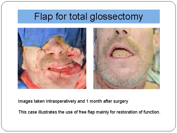 Flap for total glossectomy Images taken Intraoperatively and 1 month after surgery This case