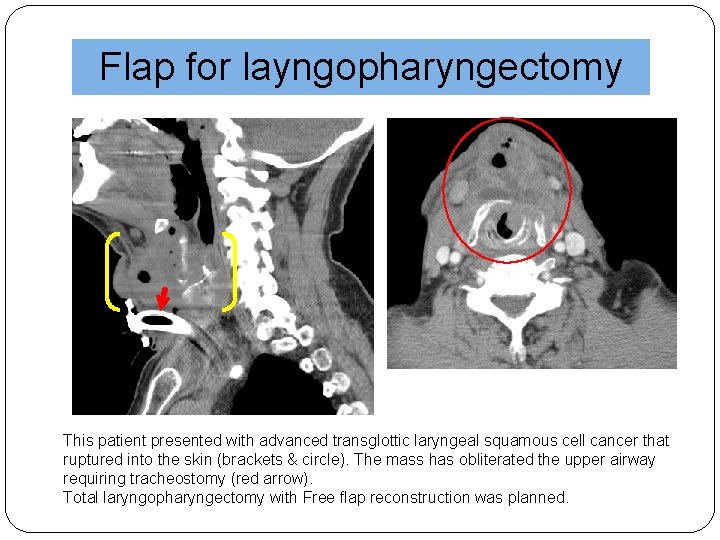 Flap for layngopharyngectomy This patient presented with advanced transglottic laryngeal squamous cell cancer that