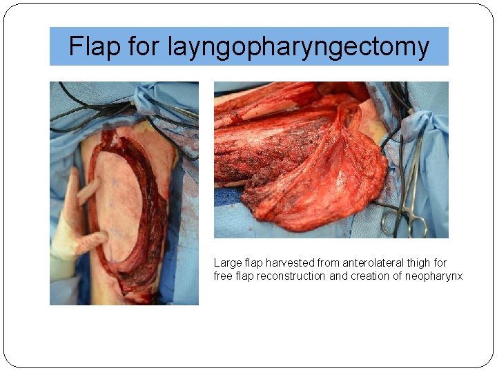 Flap for layngopharyngectomy Large flap harvested from anterolateral thigh for free flap reconstruction and