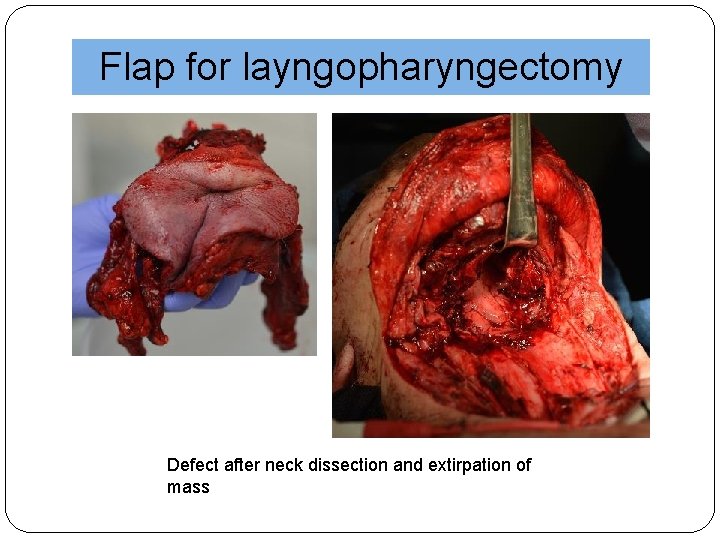 Flap for layngopharyngectomy Defect after neck dissection and extirpation of mass 