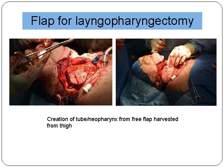 Flap for layngopharyngectomy Creation of tube/neopharynx from free flap harvested from thigh 