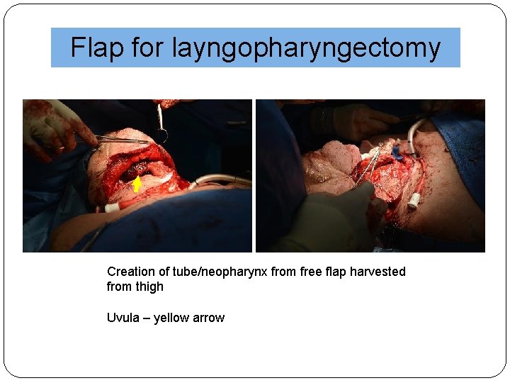 Flap for layngopharyngectomy Creation of tube/neopharynx from free flap harvested from thigh Uvula –