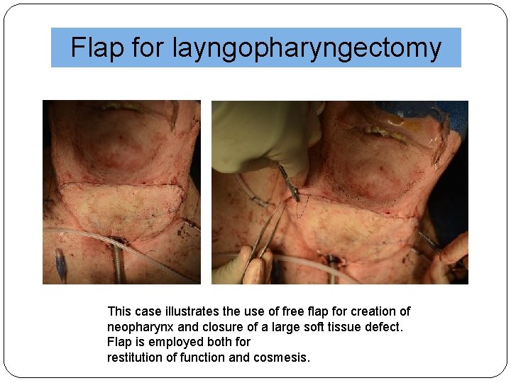 Flap for layngopharyngectomy This case illustrates the use of free flap for creation of