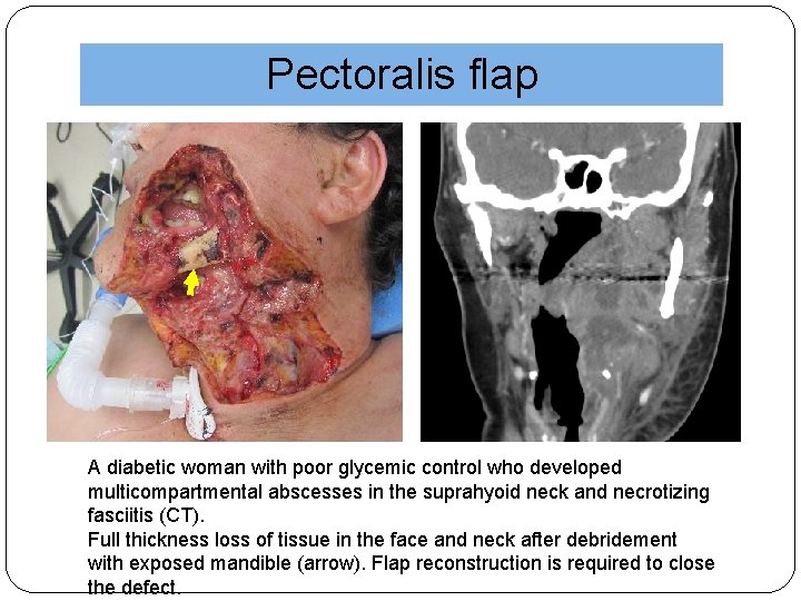 Pectoralis flap A diabetic woman with poor glycemic control who developed multicompartmental abscesses in