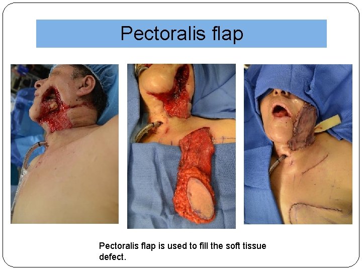 Pectoralis flap is used to fill the soft tissue defect. 
