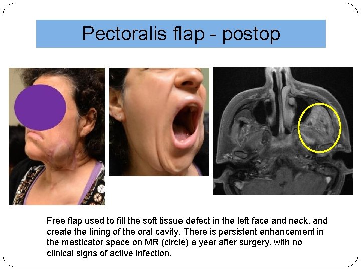 Pectoralis flap - postop Free flap used to fill the soft tissue defect in