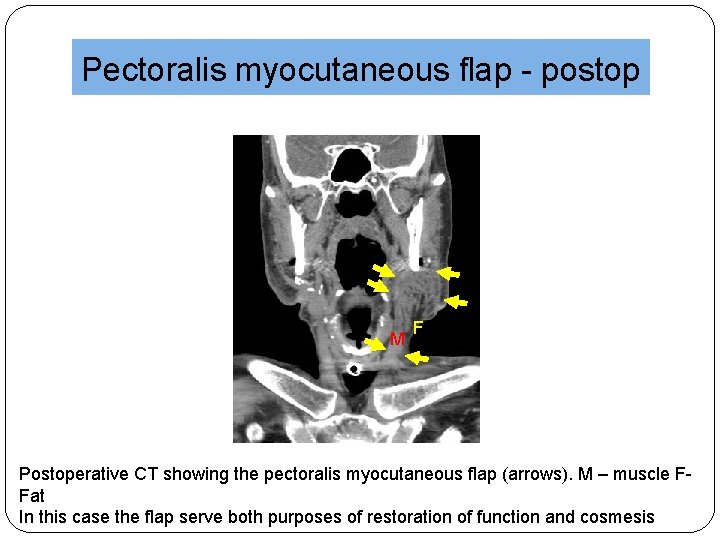 Pectoralis myocutaneous flap - postop M F Postoperative CT showing the pectoralis myocutaneous flap