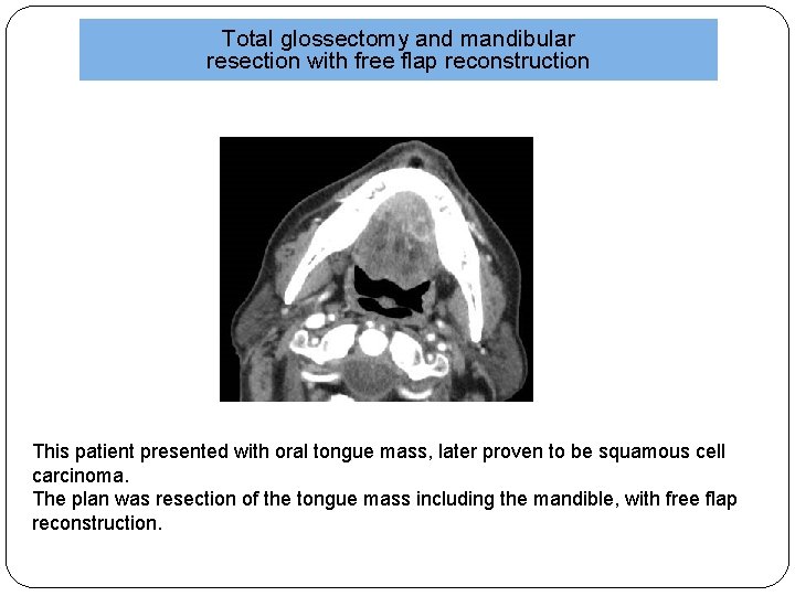 Total glossectomy and mandibular resection with free flap reconstruction This patient presented with oral