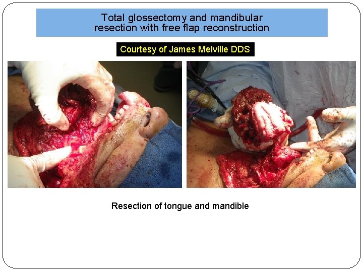 Total glossectomy and mandibular resection with free flap reconstruction Courtesy of James Melville DDS