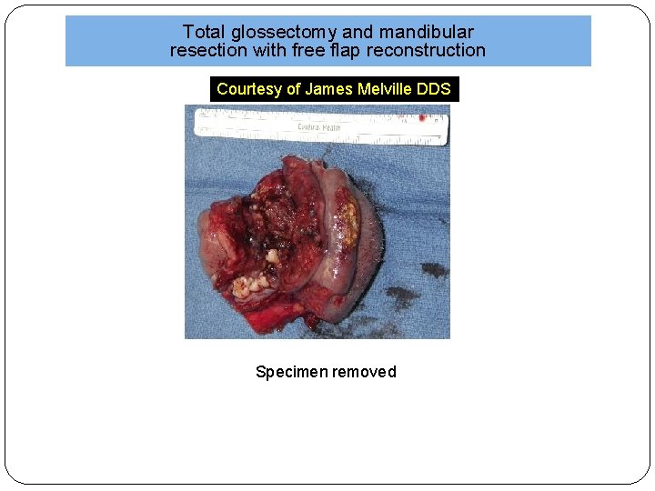 Total glossectomy and mandibular resection with free flap reconstruction Courtesy of James Melville DDS