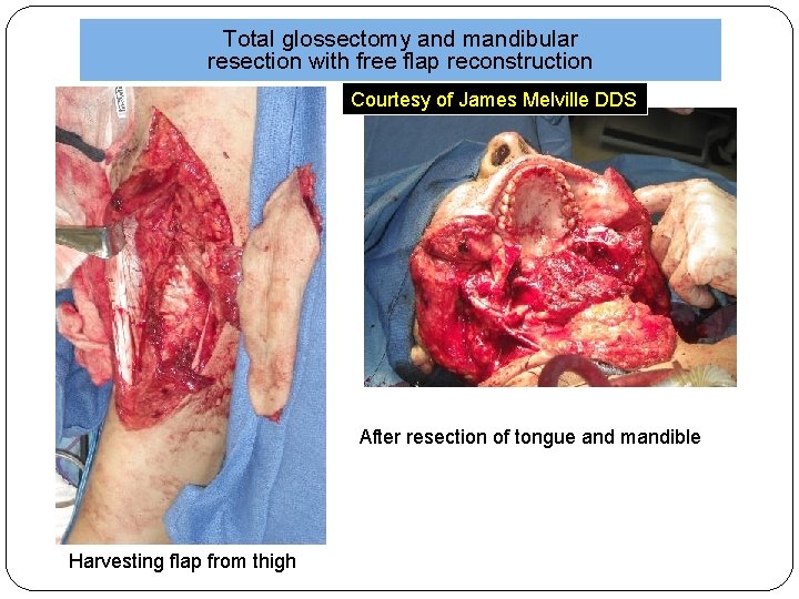 Total glossectomy and mandibular resection with free flap reconstruction Courtesy of James Melville DDS