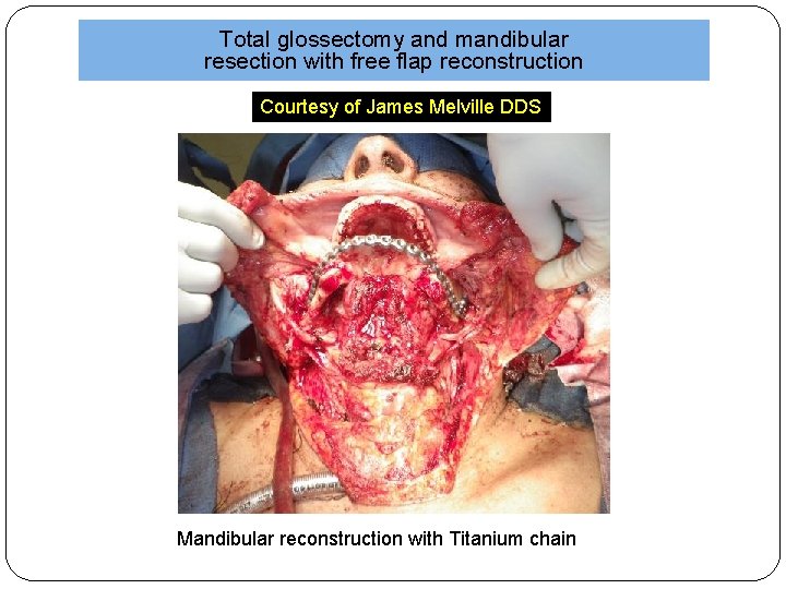 Total glossectomy and mandibular resection with free flap reconstruction Courtesy of James Melville DDS