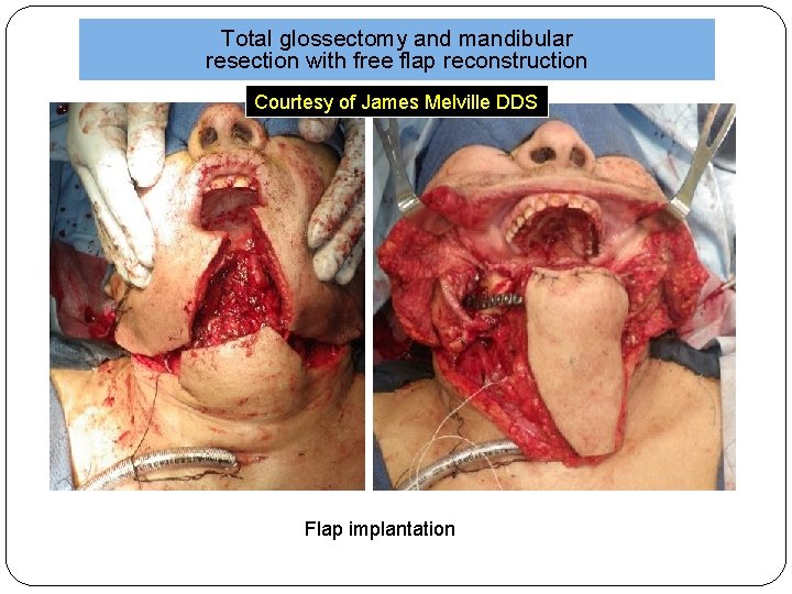 Total glossectomy and mandibular resection with free flap reconstruction Courtesy of James Melville DDS