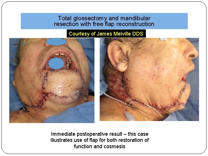 Total glossectomy and mandibular resection with free flap reconstruction Courtesy of James Melville DDS