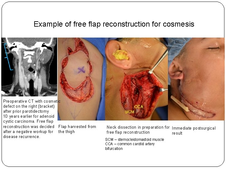 Example of free flap reconstruction for cosmesis Preoperative CT with cosmetic defect on the
