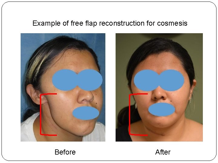 Example of free flap reconstruction for cosmesis Before After 