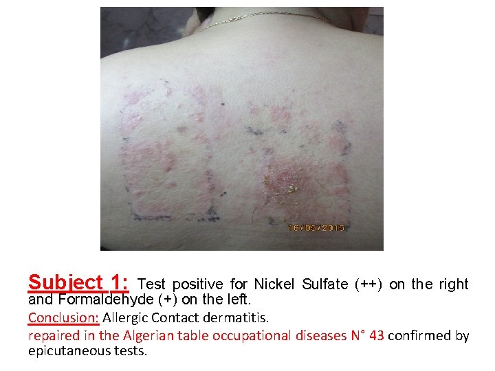 Subject 1: Test positive for Nickel Sulfate (++) on the right and Formaldehyde (+)