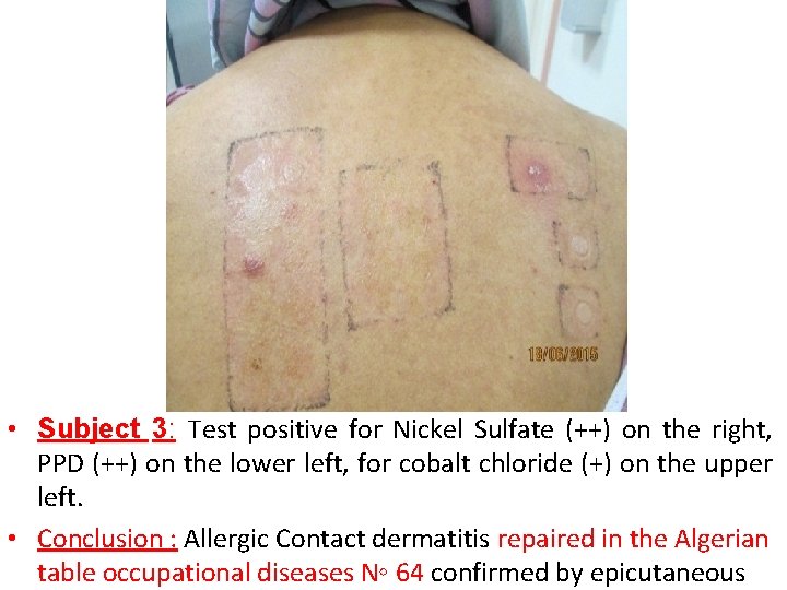  • Subject 3: Test positive for Nickel Sulfate (++) on the right, PPD