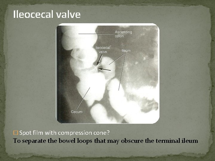 Ileocecal valve � Spot film with compression cone? To separate the bowel loops that