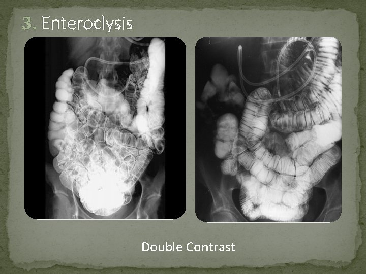 3. Enteroclysis Double Contrast 