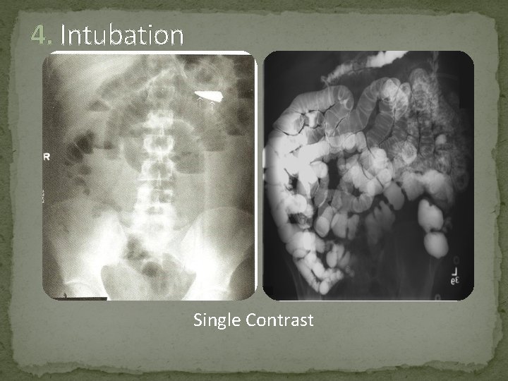 4. Intubation Single Contrast 