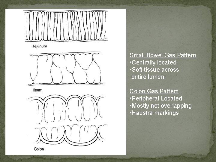 Small Bowel Gas Pattern • Centrally located • Soft tissue across entire lumen Colon