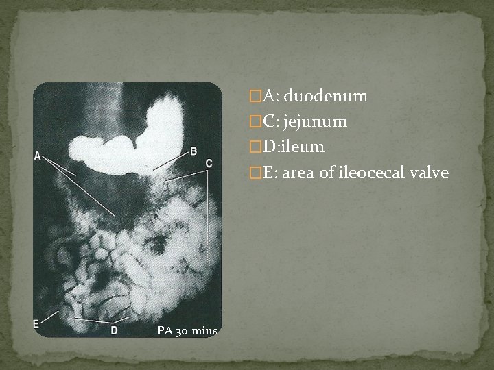 �A: duodenum �C: jejunum �D: ileum �E: area of ileocecal valve PA 30 mins