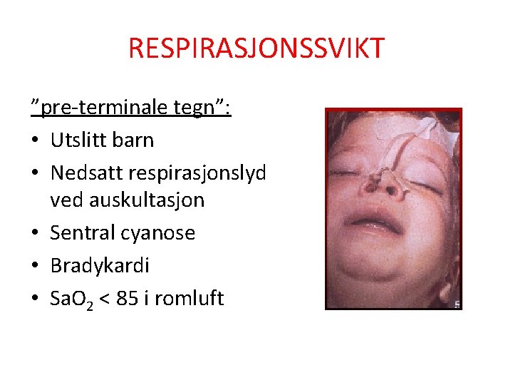 RESPIRASJONSSVIKT ”pre-terminale tegn”: • Utslitt barn • Nedsatt respirasjonslyd ved auskultasjon • Sentral cyanose