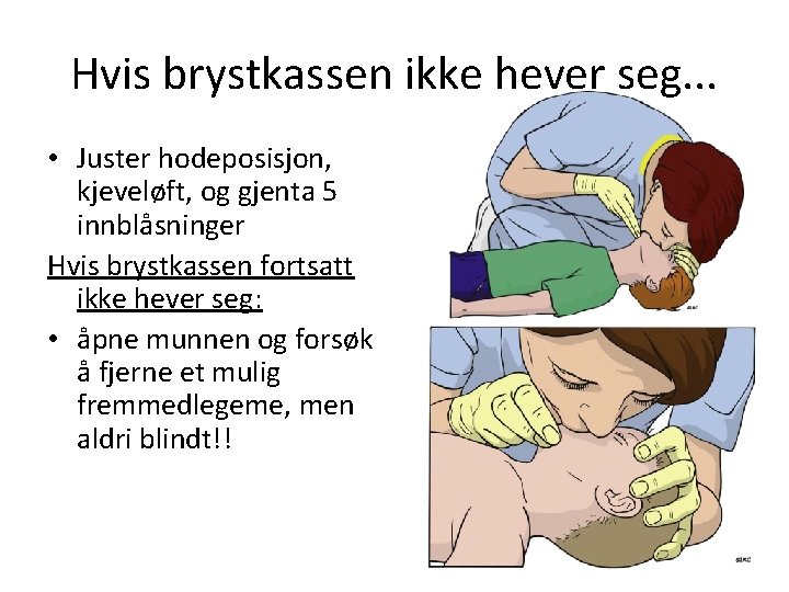 Hvis brystkassen ikke hever seg. . . • Juster hodeposisjon, kjeveløft, og gjenta 5