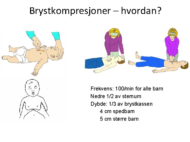 Brystkompresjoner – hvordan? n n n Frekvens: 100/min for alle barn Nedre 1/2 av